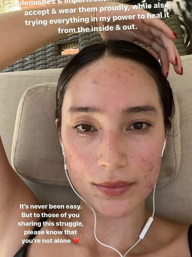 Potret 6 Seleb Unggah Foto Bare Face Lagi Berjerawat, Cintai Diri Sendiri Apa Adanya
