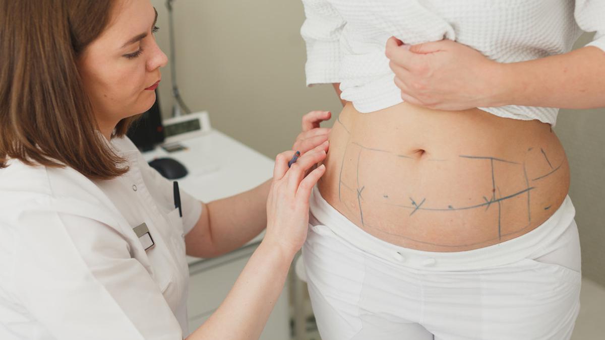 Jangan Salah Kaprah, Liposuction Bukan untuk Ngurusin Badan! - Health Liputan6.com