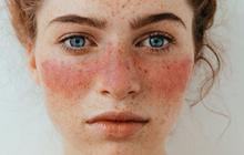 Gejala Penyakit Lupus pada Anak dan Cara Mengatasinya, Jangan Diabaikan