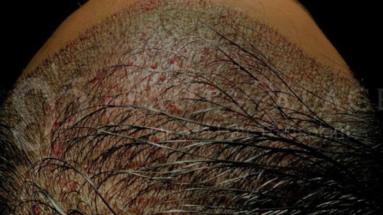 Atasi Kebotakan, Begini Cara Tanam Rambut yang Jarang Diketahui Orang