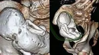 Langka, Wanita Ini Tak Sadar Sudah Mengandung Bayi Selama 35 Tahun