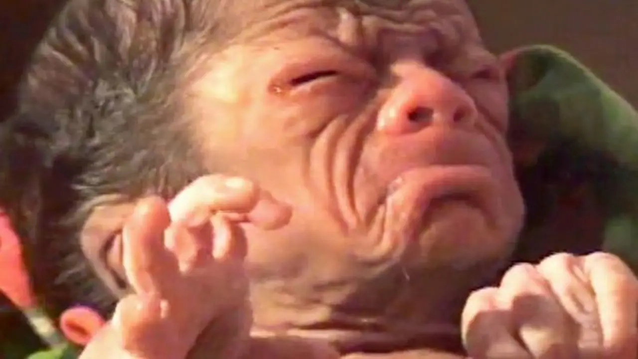 Bayi seperti kakek 80 tahun. Foto: Mirror