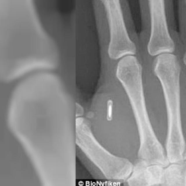 Apa Yang Terjadi Jika Microchip Ditanam Dalam Tubuh Manusia Global Liputan6 Com
