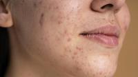 ilustrasi jerawat akibat rusaknya skin barrier/copyright&nbsp;freepik.com/freepik