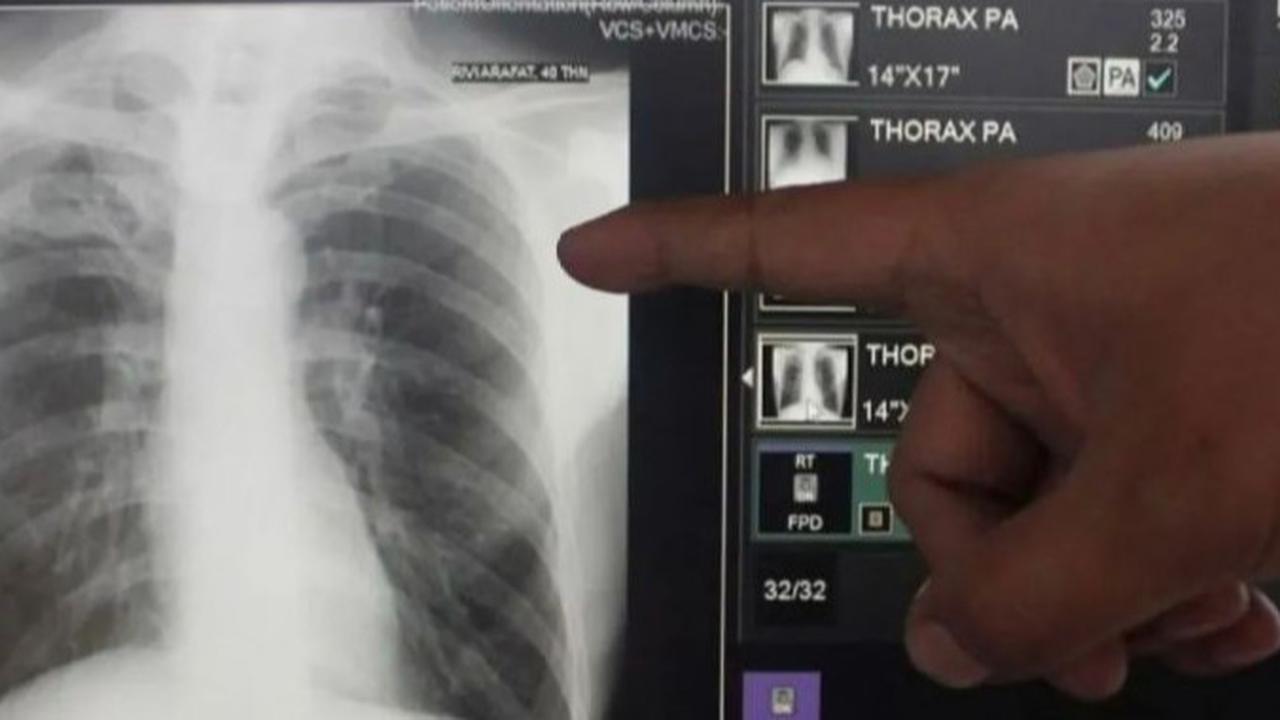 Banyak Pasien Tak Tahan Minum Obat Terus, Menkes Bakal Sederhanakan Pengobatan TBC dari 6 Bulan jadi 90 Hari