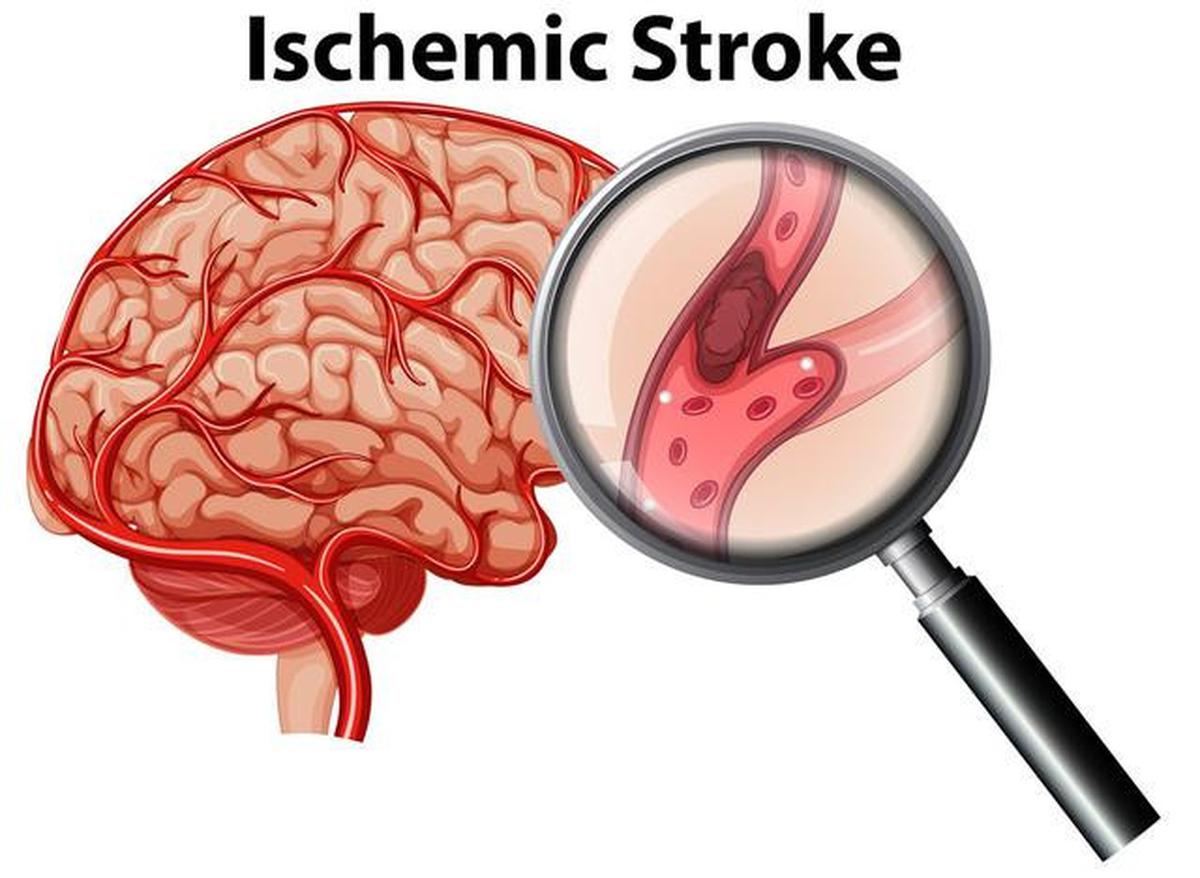 Kenali Risiko Stroke Sejak Dini, Begini Gejala dan Cara Penanganannya