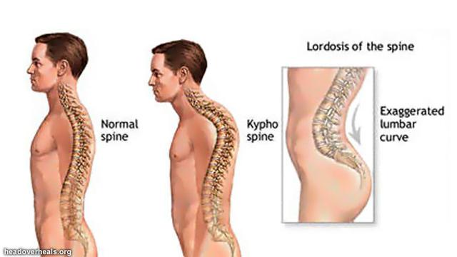 Ke membengkok ke kelainan disebut belakang kanan disebut tulang kondisi bagian atau punggung tulang kiri dimana Mengenal Struktur