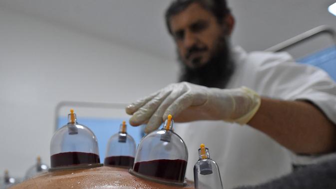 Spesialis melakukan pengobatan hijama atau terapi bekam basah kepada pasien di sebuah klinik di Ajman, Uni Emirat Arab, Kamis (15/8/2019). Hijama berasal dari istilah bahasa Arab yang berarti pelepasan darah kotor. (KARIM SAHIB/AFP)
