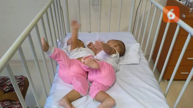 Bayi Kembar Siam