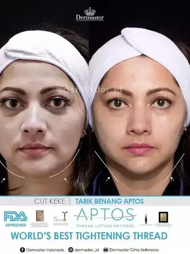 Potret Cut Keke sebelum dan sesudah tanam benang (Sumber: Instagram/dermaster_id)