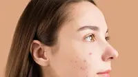 ilustrasi jerawat (Photo by Anna Nekrashevich: https://www.pexels.com/photo/close-up-photo-of-a-teenager-with-pimples-on-her-face-6476065/)