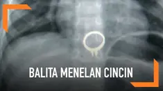 Seorang balita tidak sengaja menelan cincin berlian milik ibunya ketika bermain. Balita malang itu terpaksa menjalani operasi selama setengah jam untuk mengeluarkan cincin tersebut.