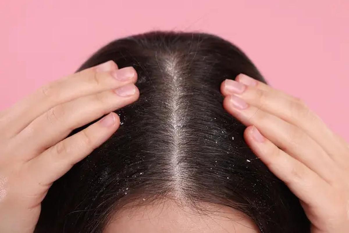 6 Manfaat Nanas untuk Kesehatan Rambut, Kurangi Ketombe Hingga Bikin Berkilau
