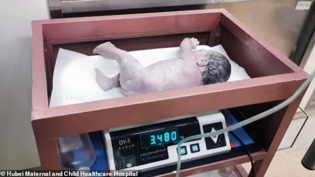 bayi kembar lahir selang 10 tahun
