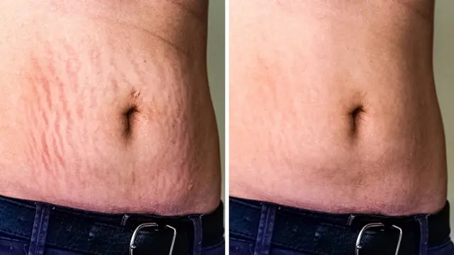 Stretch Mark
