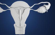 Kenali Rasa Sakit Pemasangan IUD, Berapa Lama dan Bagaimana Cara Meredakannya?