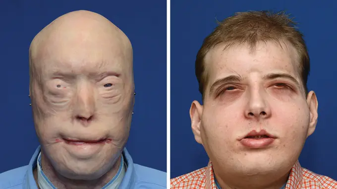 Ingin Menyelamatkan Korban, Pria Ini Malah Kehilangan Wajahnya