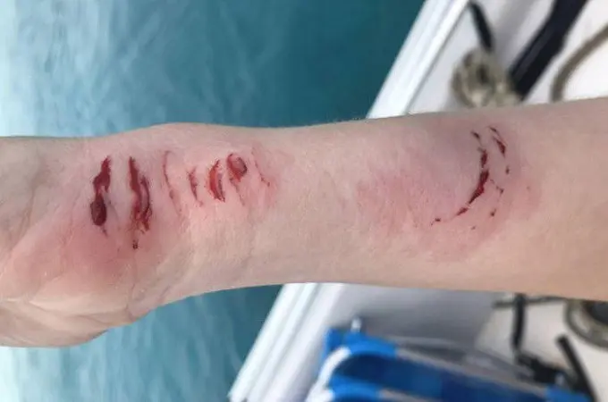 Sarah Illig mengalami luka serius akibat digigit seekor hiu perawat di Bahama, Kepulauan Karibia. (Facebook Evan Carroll)