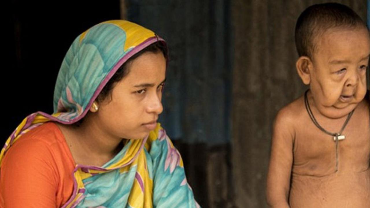 Tragis, Bocah 4 Tahun Berwajah Kakek 80 Tahun