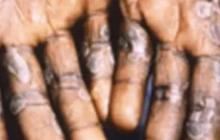 Ketahui Rekomendasi IDI bagi Masyarakat untuk Menghadapi Cacar Monyet atau Monkeypox