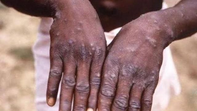 Ilustrasi Cacar Monyet (Istimewa)