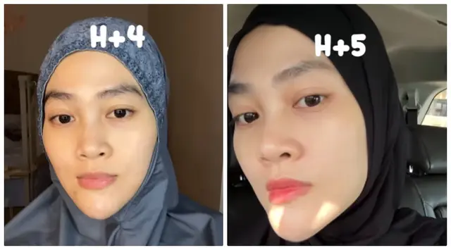 6 Potret tranformasi wajah Henny Rahman istri Alvin Faiz usai perawatan, berubah glowing dan mulus