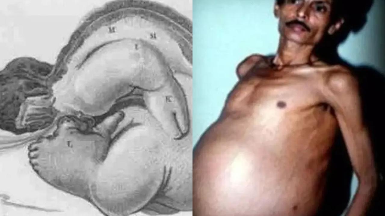 Pria Punya Kembaran di Dalam Perut