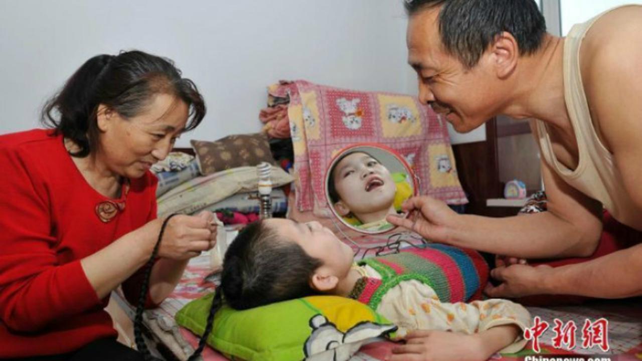 Mengharukan, Ortu Ini 15 Tahun Suapi Anaknya dari Mulut ke Mulut 