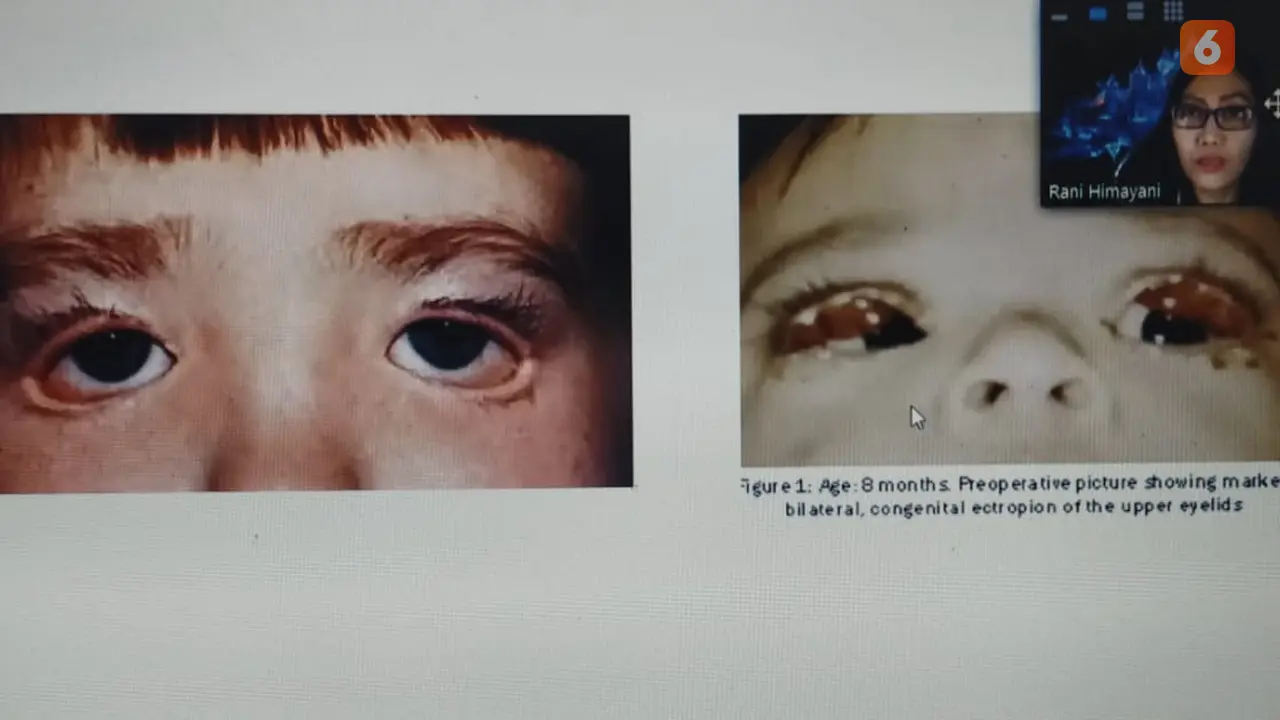 Hiperlakrimasi pada anak down syndrome