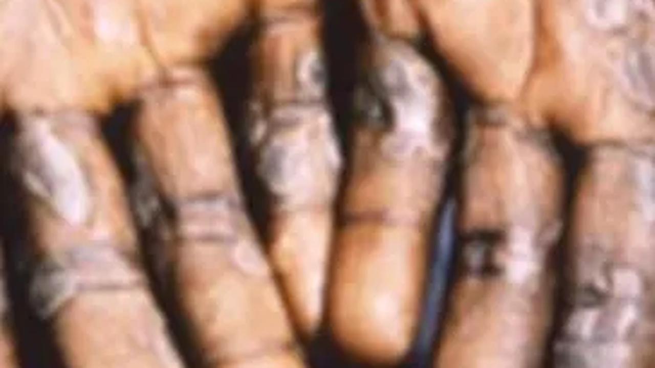 Ketahui Rekomendasi IDI bagi Masyarakat untuk Menghadapi Cacar Monyet atau Monkeypox