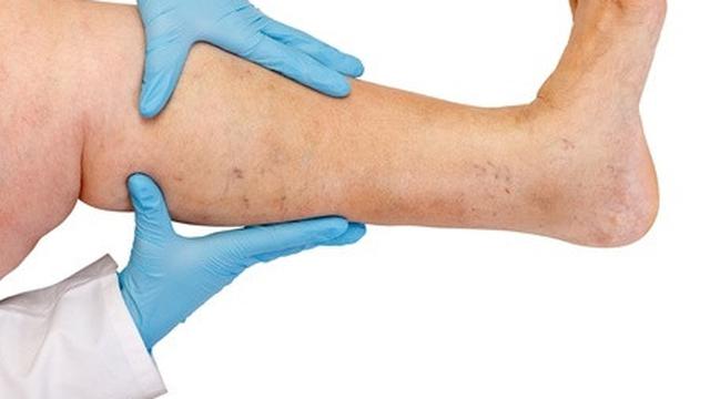 12 Gejala Pitting Edema Secara Umum, Ketahui Penyebab dan Pengobatannya