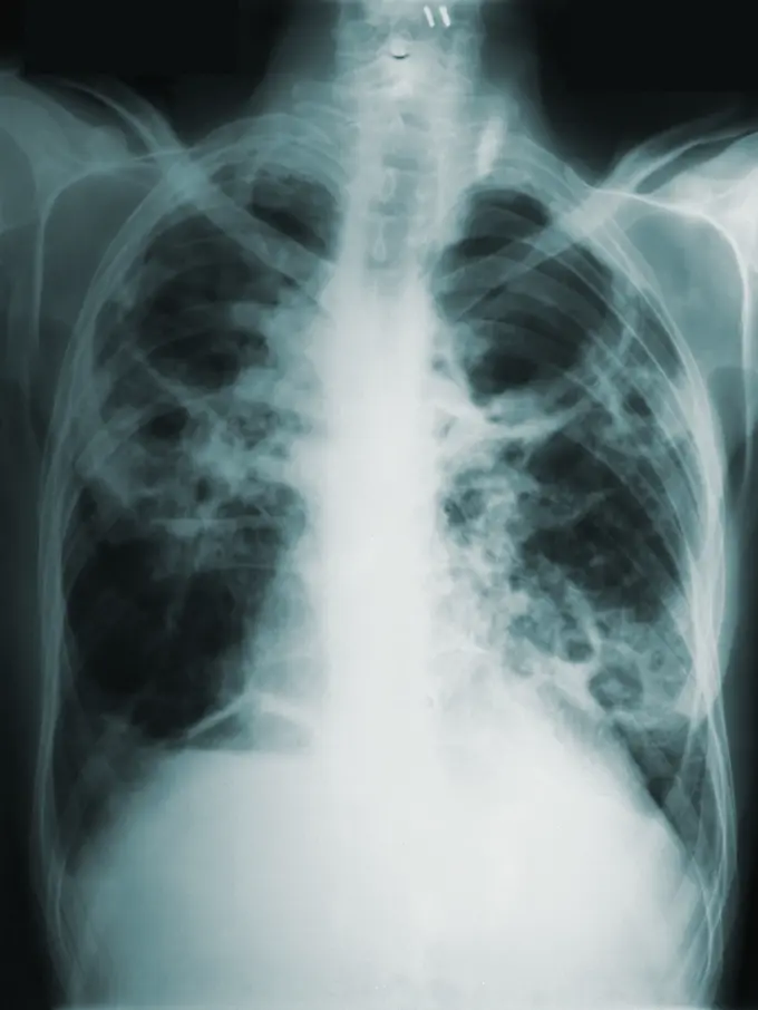 Tuberkulosis