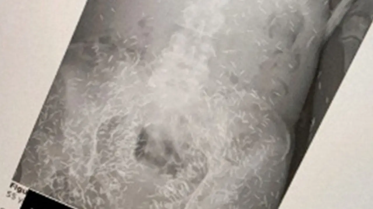 Viral Foto X-Ray Wanita dengan Ratusan Jarum Diduga Susuk Ini Bikin Heboh Netizen
