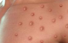 Satu Warga Suspek Monkeypox, Dinkes Sumsel Pastikan Hanya Cacar Biasa