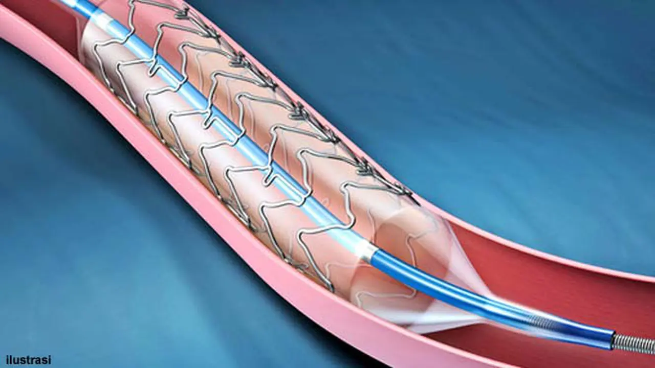 stent-130807b.jpg