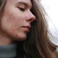 Bekas jerawat sering kali mengganggu penampilan. (Foto: Unsplash/Barbara Krysztofiak)