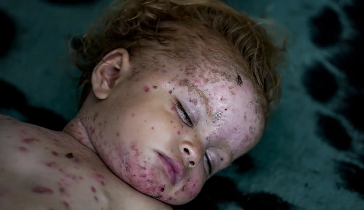 Anak-anak yang menderita dan orang tua yang cemas terus berdatangan ke ruang perawatan kulit di Rumah Sakit Nasser di pusat kota Gaza.  (AP Photo/Abdel Kareem Hana)