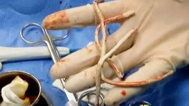 Demi Kenikmatan Seks, Kabel USB Malah Tersangkut di Penisnya