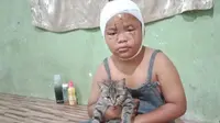 Wajah bocah ini rusak karena sering dicakar kucing liar peliharaannya. (Sumber: Siakapkeli)