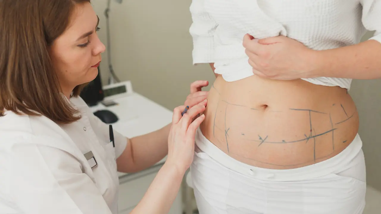 Pengalaman Menjalani Liposuction, Ternyata Nggak Menakutkan Seperti yang Banyak Beredar