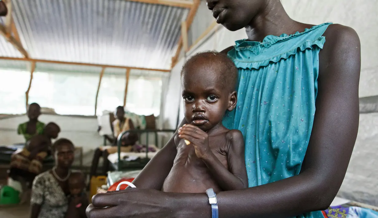 Seorang wanita menggendong anaknya yang terkena penyakit gizi burutk di sebuah klinik di Lankien, Sudan Selatan, (8/4).Setiap bulannya sekitar 150 anak mengalami gizi buruk. (Albert Gonzalez Farran / cds / AFP)