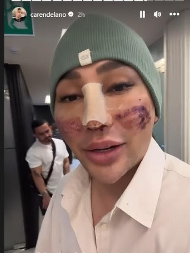 Potret Caren Delano Jalan-Jalan di Korea Usai Oplas, Wajah Masih Diperban