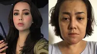 5 Potret Rency Milano Diduga Jadi Korban Malpraktik, Dagu Bengkak dan Bernanah