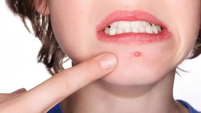 Cara Mudah Tutupi Jerawat, Aw Mau Dong!