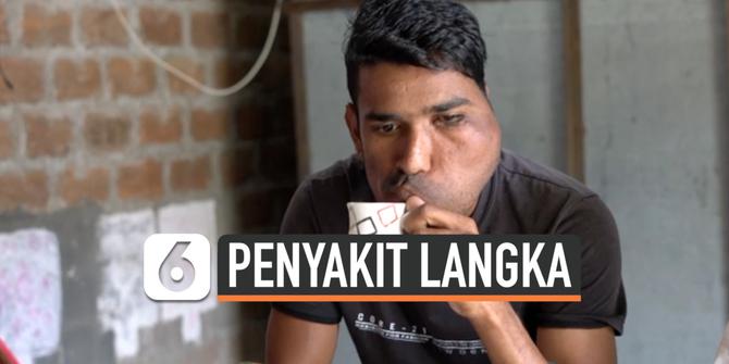 VIDEO: Idap Penyakit Langka, Wajah Pria Ini Membengkak