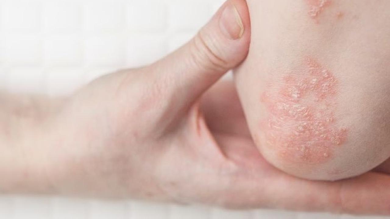 <b>2. Eksim atau dermatitis atopik</b>