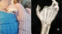 (Credit: Oriental Daily) Akibat insiden ponsel meledak, bocah 12 tahun asal Tiongkok mengalami luka parah pada tubuhnya. tak hanya mengalami kerusahkan pengelihatan pada bola mata kanannya, ia juga kehilangan jari telunjuk.