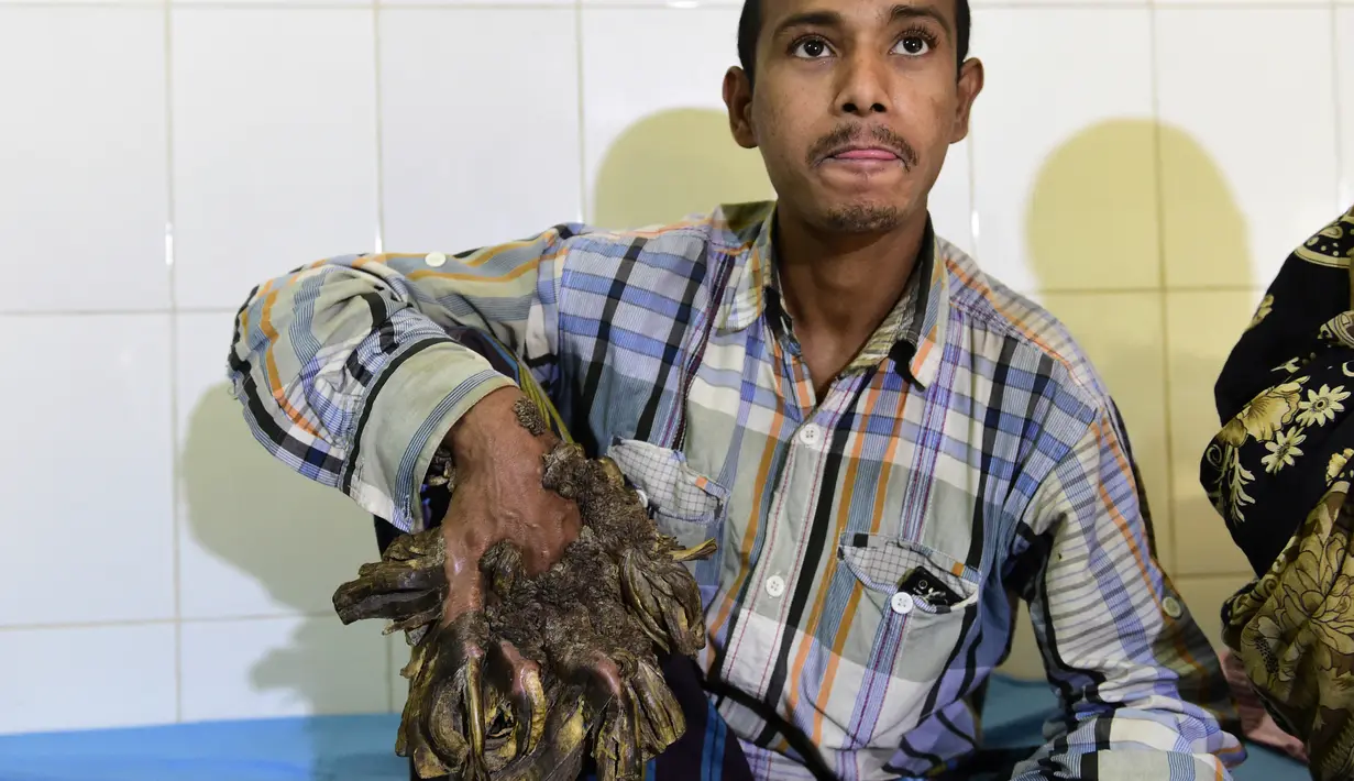 Abul Bajandar (26) menunjukkan tangannya yang ditumbuhi kutil berlebih saat dirawat di Dhaka Medical College dan Rumah Sakit, Bangladesh, Minggu (31/1). Kini kedua tangannya sudah tak bisa berfungsi sebagaimana biasanya. (AFP Photo/Munir uz ZAMAN)