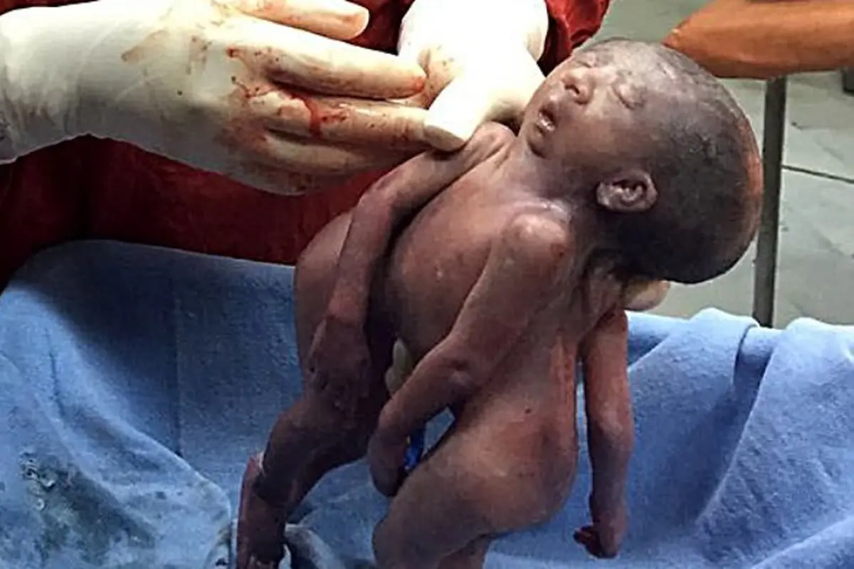 Ngeri, Bayi Kembar Siam Ini Lahir dengan Satu Kepala