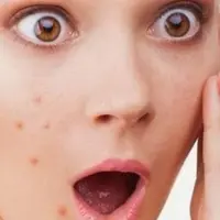 Jerawat kamu yang membandel, bisa teratasi dengan bahan alami loh.